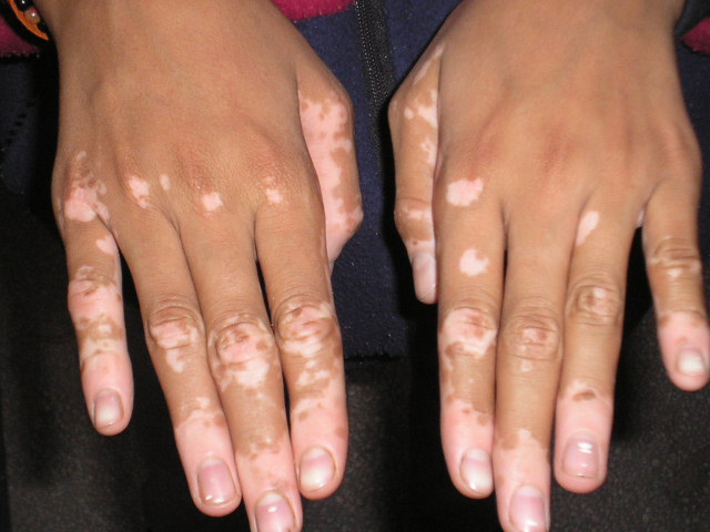 Vitiligo