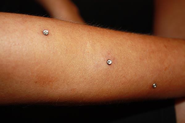 dermal